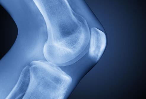 What is Osteoarthritis?