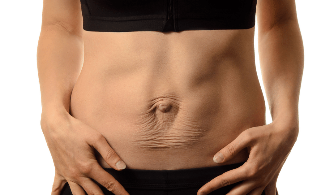 woman with a diastasis who is being treated in bend oregon