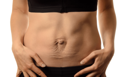Diastasis Recti – Understanding and Managing with Exercise
