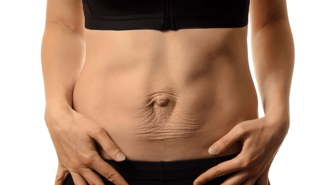 Diastasis Recti - Understanding and Managing with Exercise